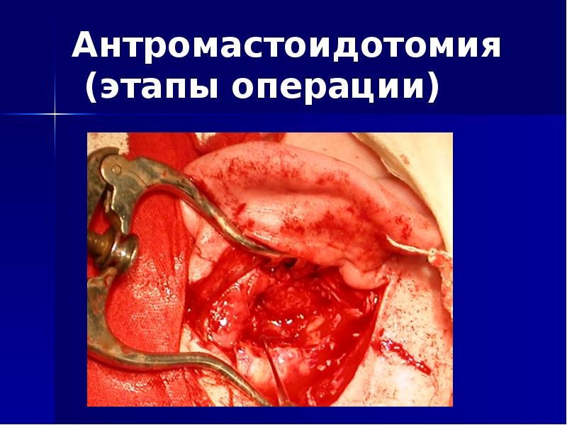 Антромастоидотомия  (этапы операции)