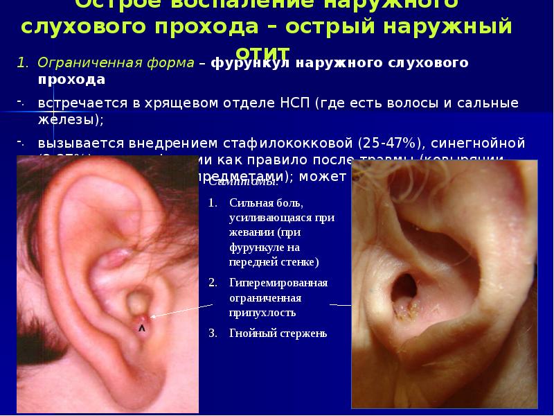 Острое воспаление наружного слухового прохода – острый наружный отит