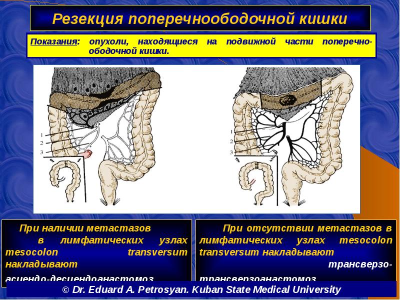 Резекция поперечноободочной кишки