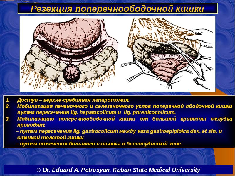 Резекция поперечноободочной кишки
