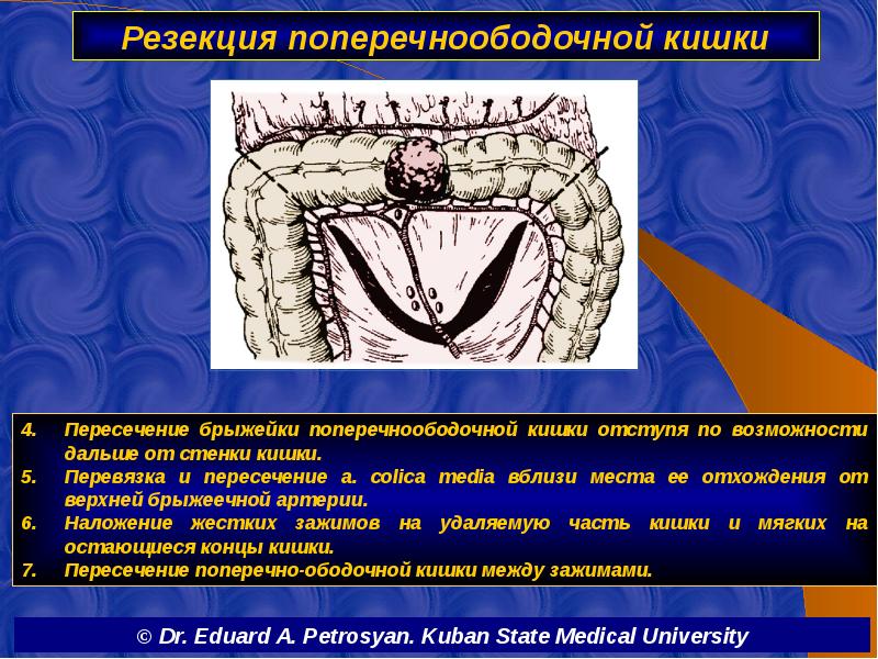 Резекция поперечноободочной кишки