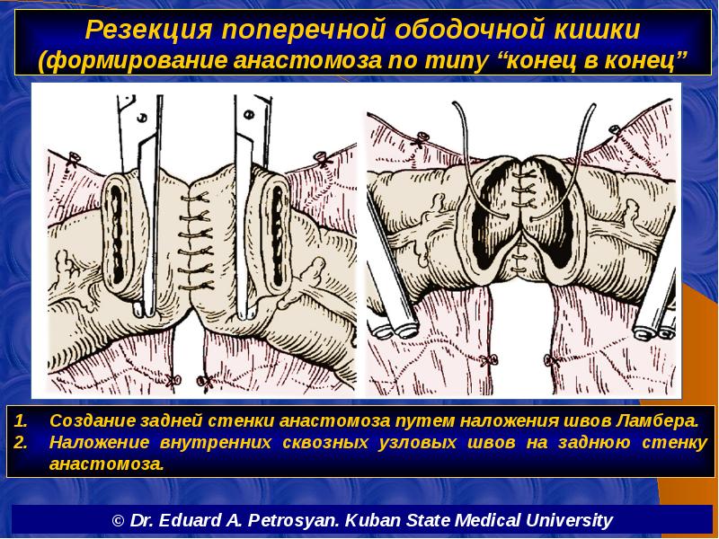 Резекция поперечной ободочной кишки (формирование анастомоза по типу “конец в конец”