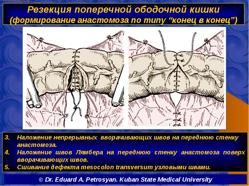 Резекция поперечной ободочной кишки (формирование анастомоза по типу “конец в конец”)