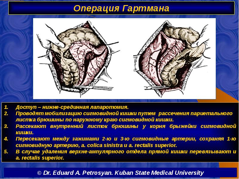 Операция Гартмана