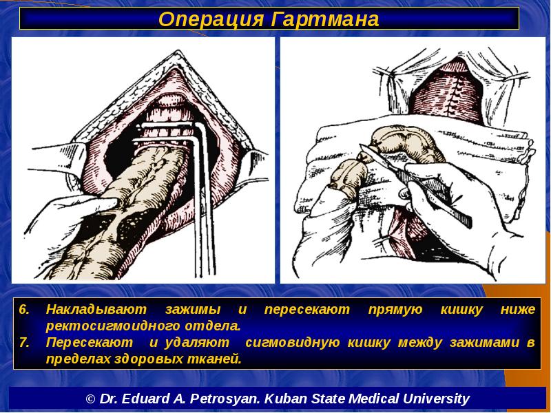 Схема операция гартмана