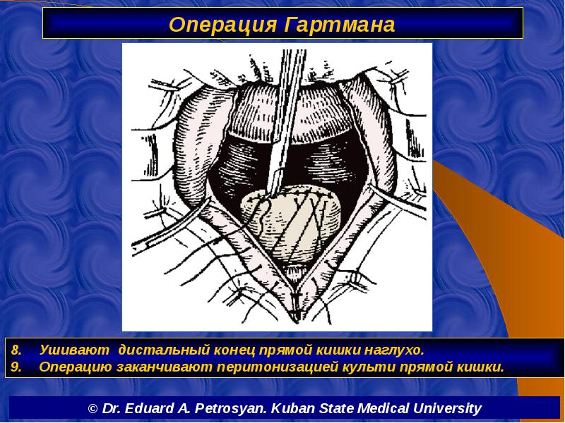 Операция Гартмана