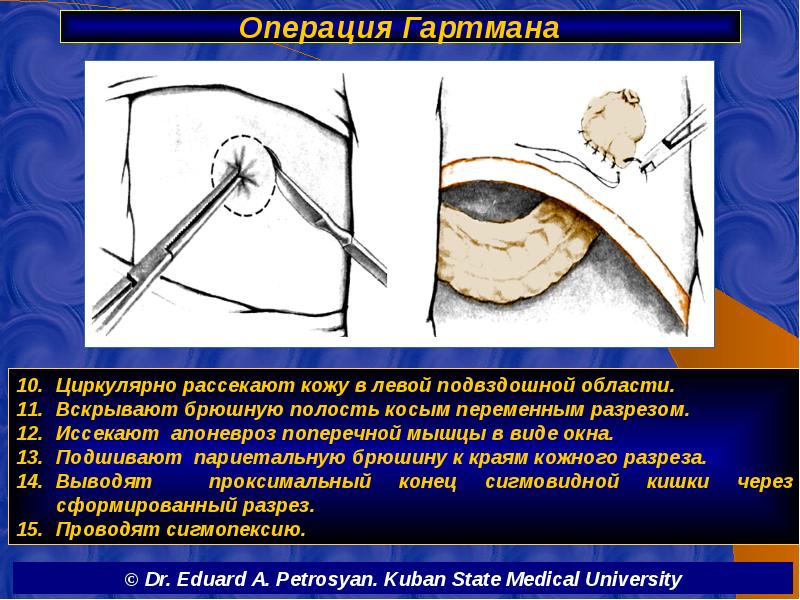 Операция Гартмана