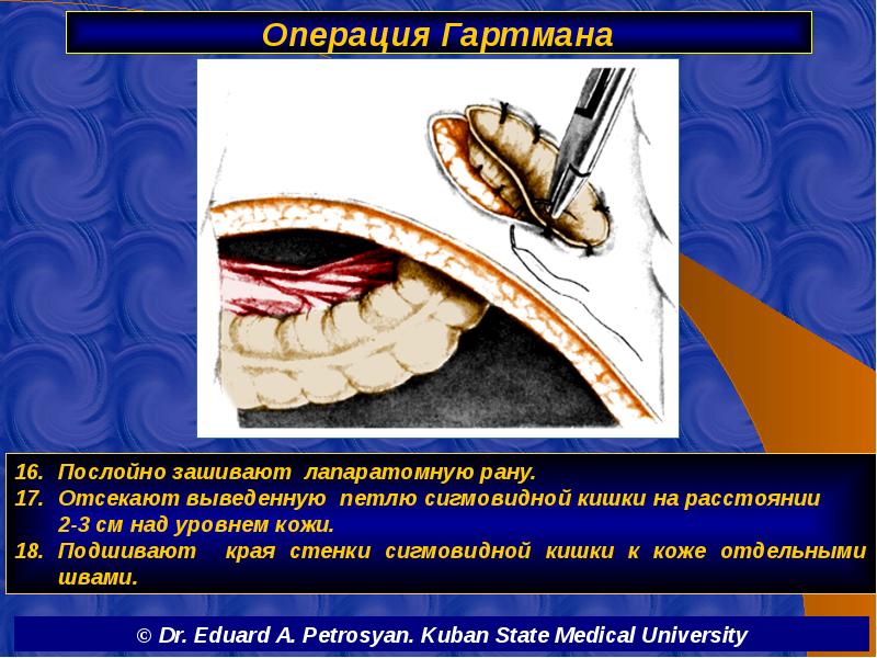 Операция Гартмана