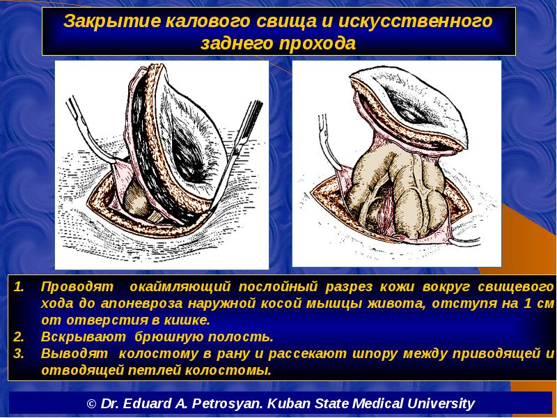 Закрытие калового свища и искусственного заднего прохода