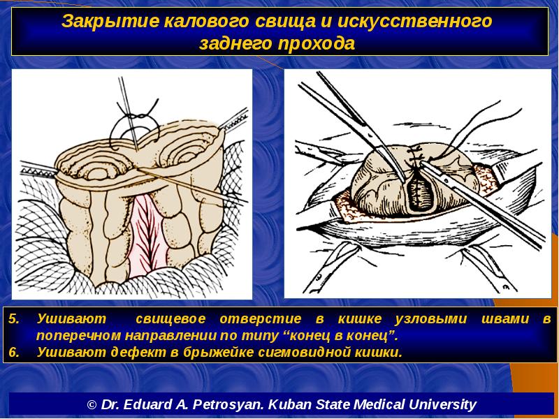 Закрытие калового свища и искусственного  заднего прохода