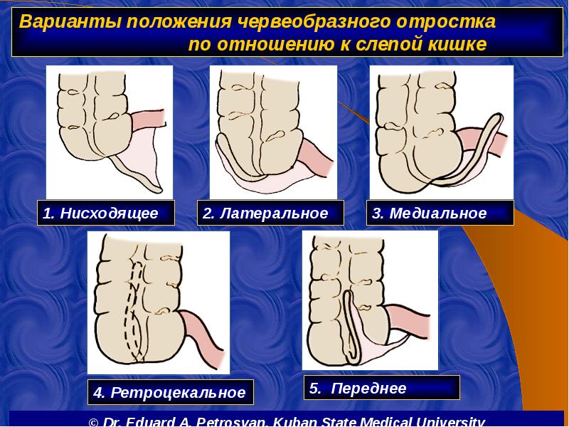 Варианты положения червеобразного отростка       