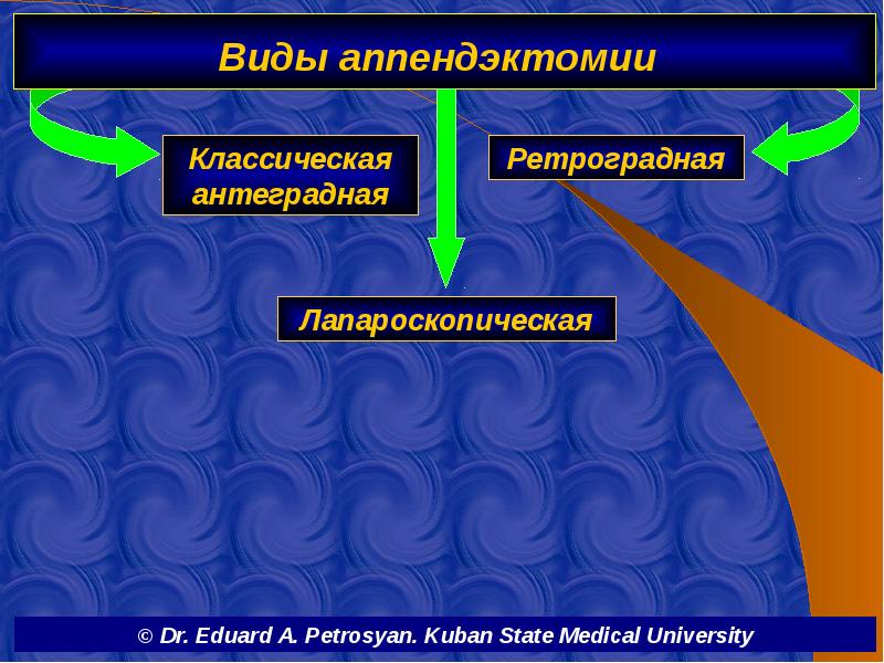 Виды аппендэктомии