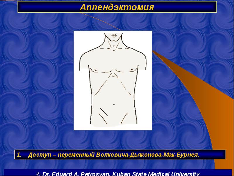 Аппендэктомия