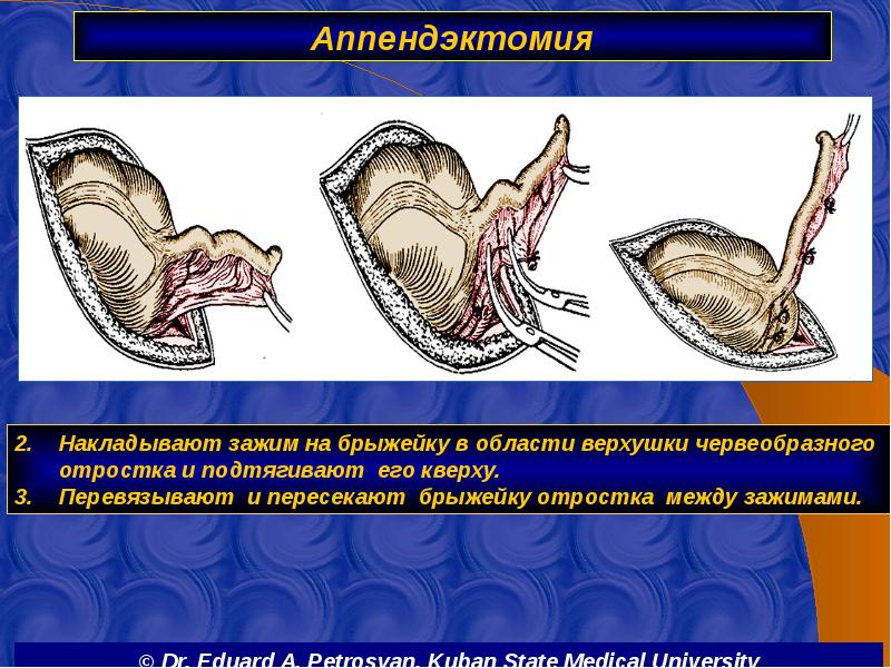 Аппендэктомия
