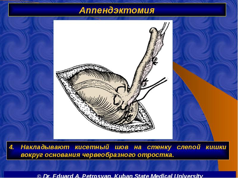 Аппендэктомия