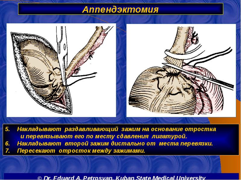 Аппендэктомия