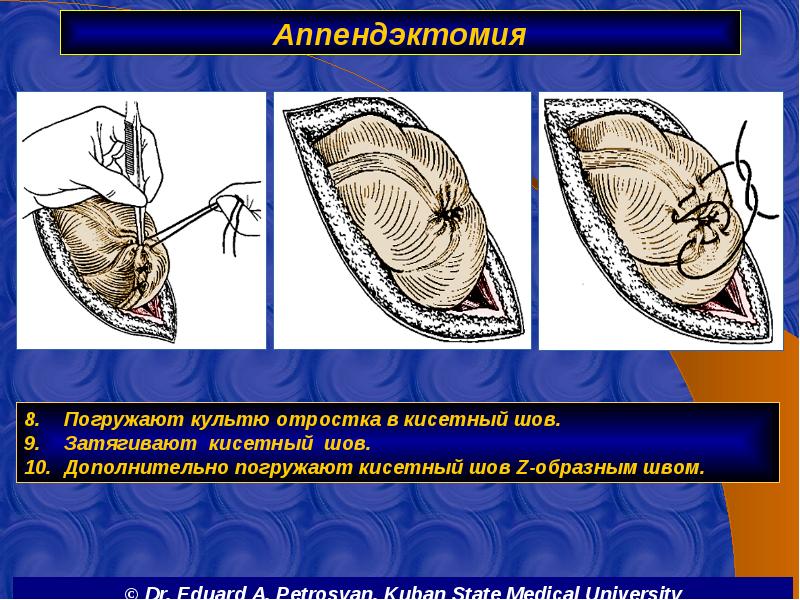 Аппендэктомия