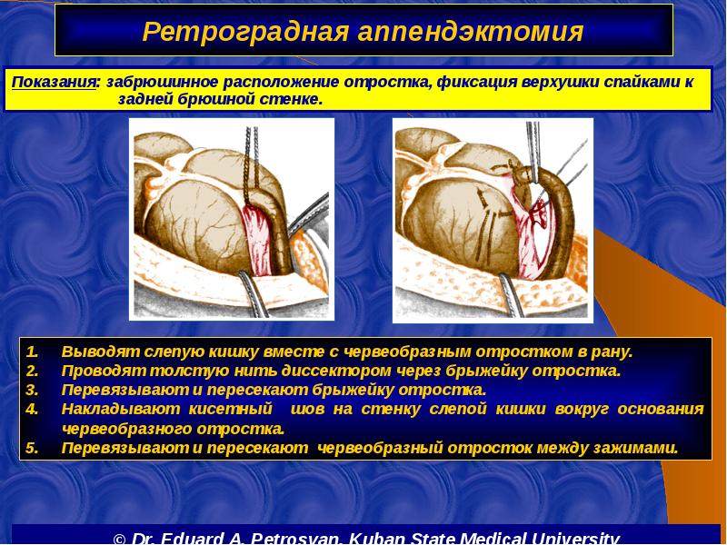 Ретроградная аппендэктомия