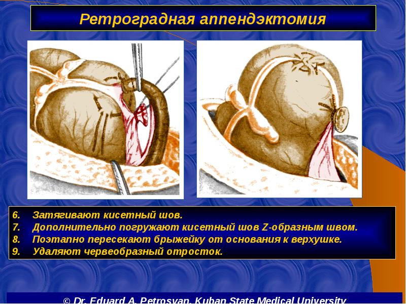 Ретроградная аппендэктомия