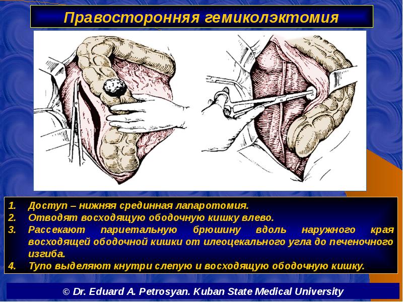 Правосторонняя гемиколэктомия