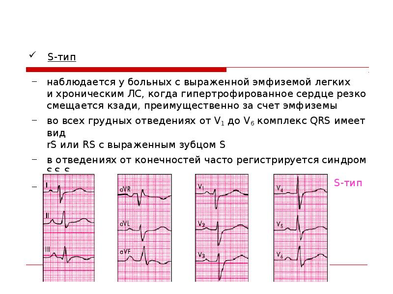 Хроническое легочное сердце презентация