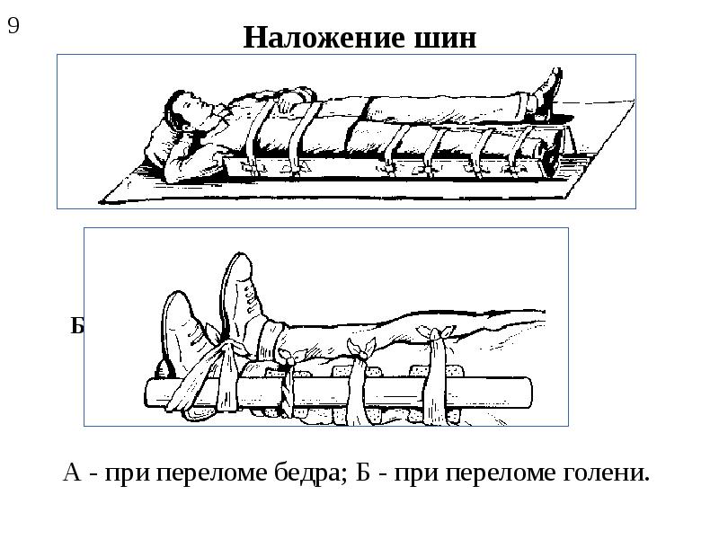 Шина бедро голень. Перелом голени наложение шины. Наложение шины при переломе бедра. Наложение шины при переломе костей голени. При переломе голени шина накладывается.