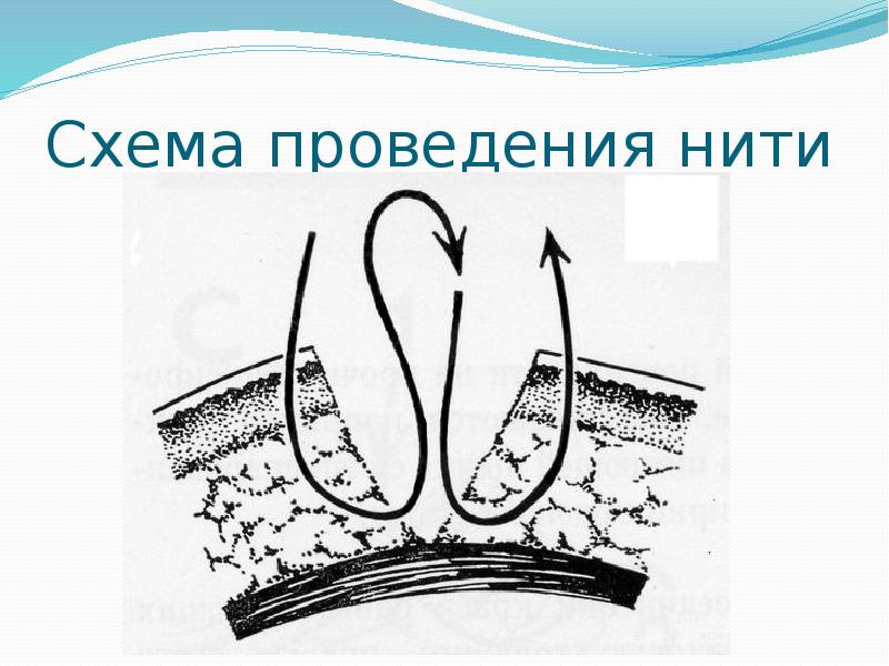 Схема проведения нити