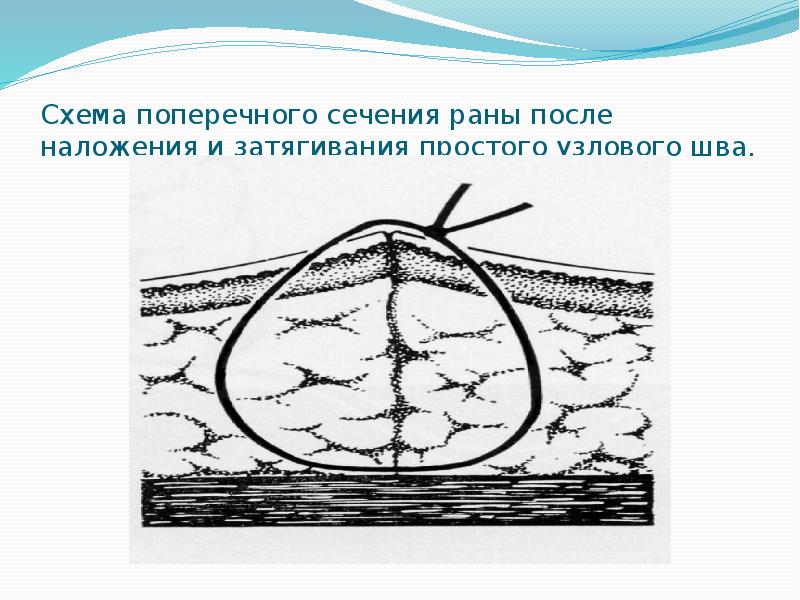 Схема поперечного сечения раны после наложения и затягивания простого узлового шва.