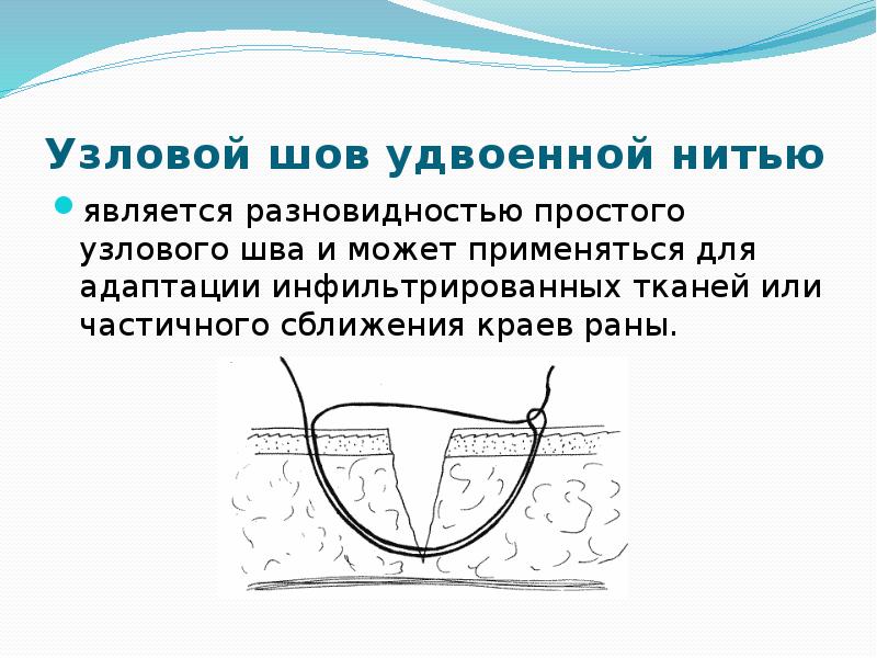 Узловой шов удвоенной нитью является разновидностью простого узлового шва и может