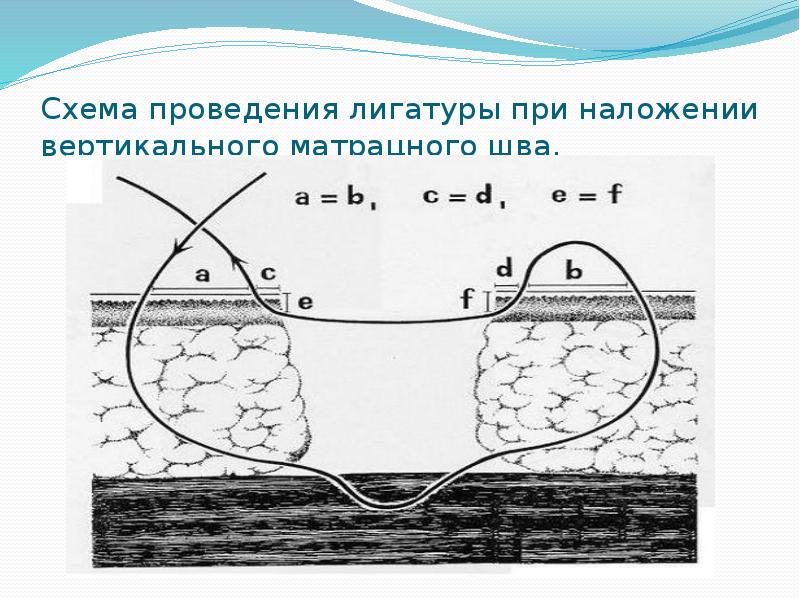 Схема проведения лигатуры при наложении вертикального матрацного шва.