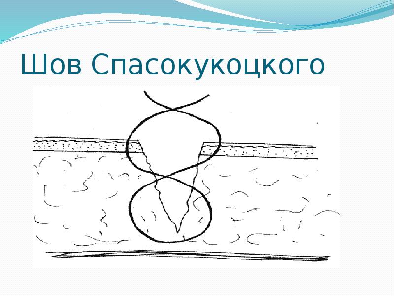 Шов Спасокукоцкого