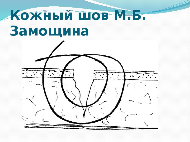 Кожный шов М.Б. Замощина