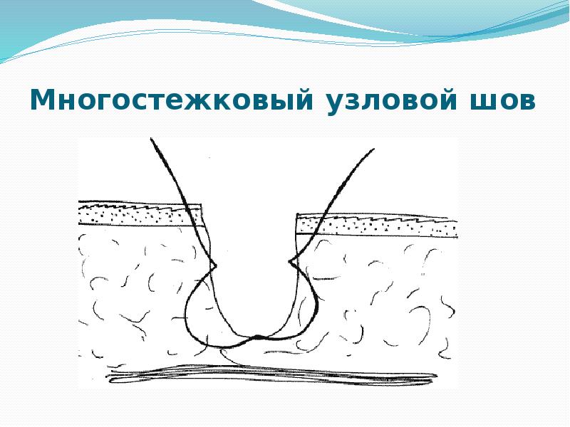 Многостежковый узловой шов