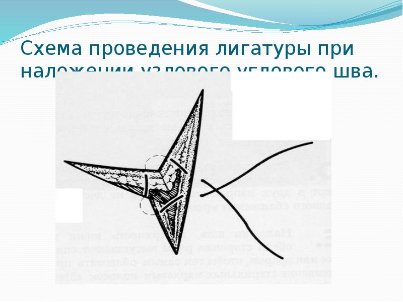 Схема проведения лигатуры при наложении узлового углового шва.