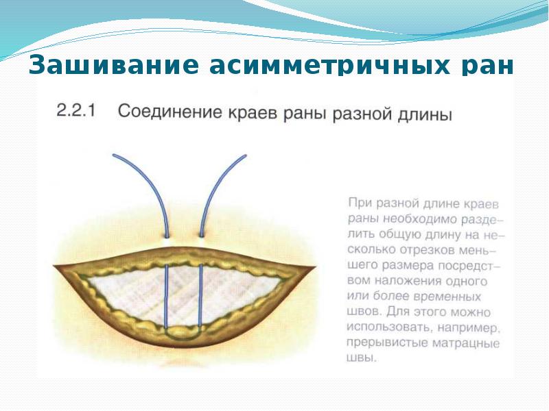 Зашивание асимметричных ран