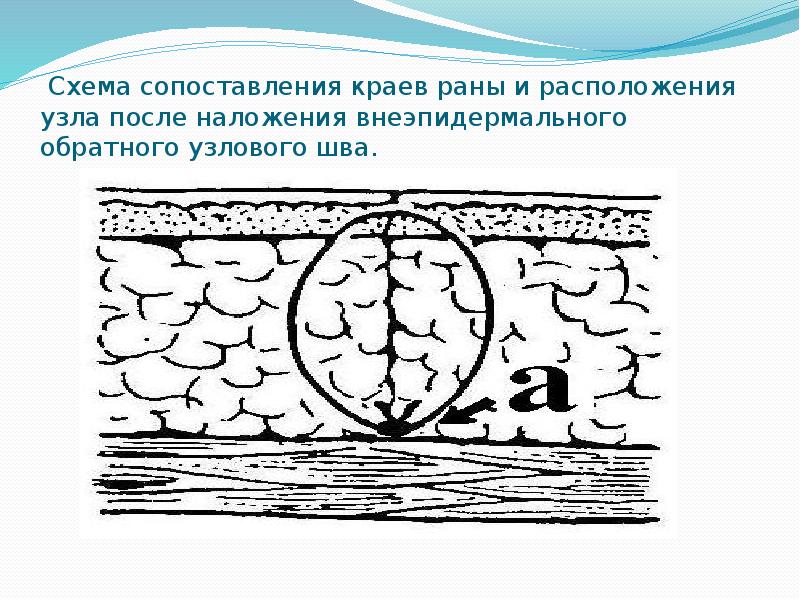 &nbsp;Схема сопоставления краев раны и расположения узла после наложения внеэпидермального обратного