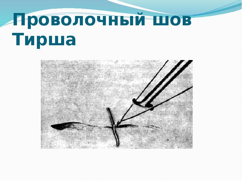 Проволочный шов Тирша