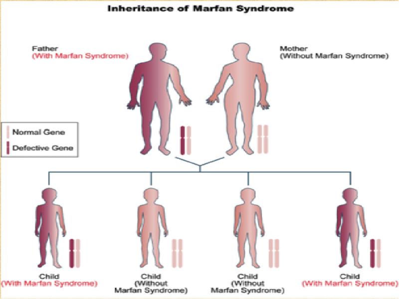 Синдром марфана дети фото