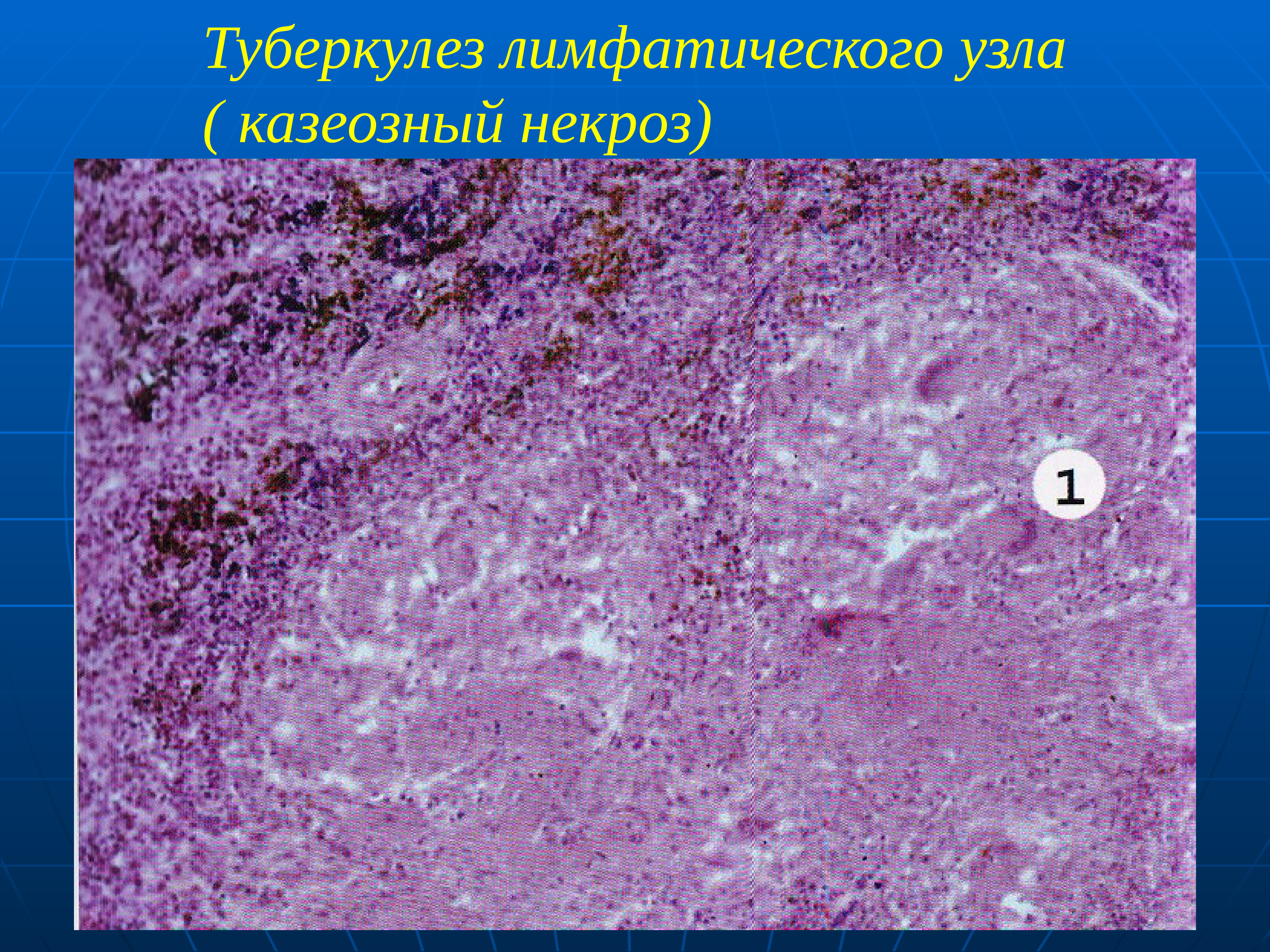 Микропрепарат лимфатический узел. Туберкулез казеозный некроз лимфоузла. Туберкулема патологическая анатомия. Творожистый некроз лимфатического узла микропрепарат. Туберкулез лимфатического узла микропрепарат.