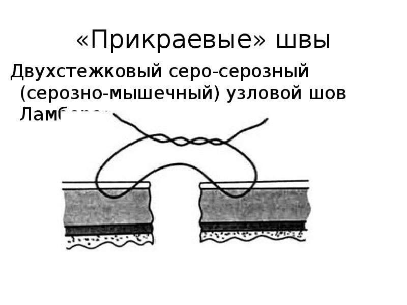 Судьба серозно мышечных узловых кишечных швов при неосложненном заживлении раны кишечной стенки