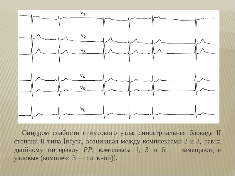 Синдром слабости синусового узла карта вызова смп
