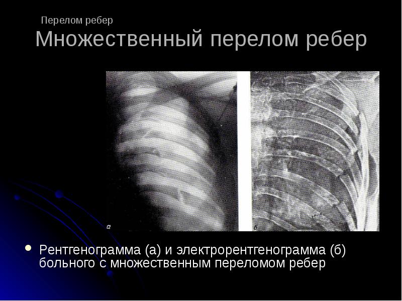 Перелом ребра: виды, причины и лечение