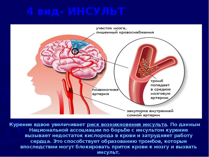 Мозгу не хватает кислорода что делать. Недостаток кислорода в крови. Курение и инсульт взаимосвязь.