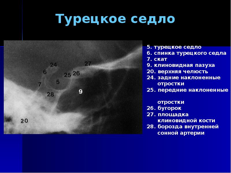 Турецкое седло это