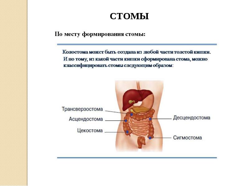 Виды стом презентация