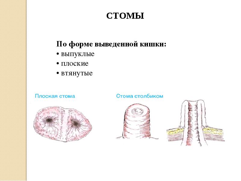 Колостома двуствольная схема