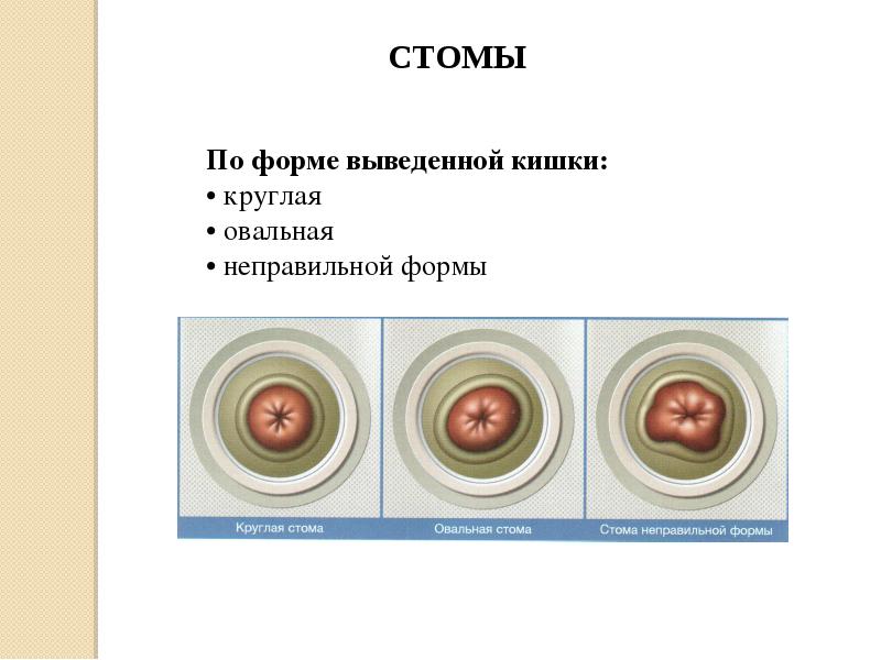 Стома питание при стоме. Классификация стом.