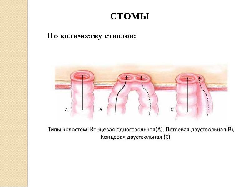 Виды стом презентация