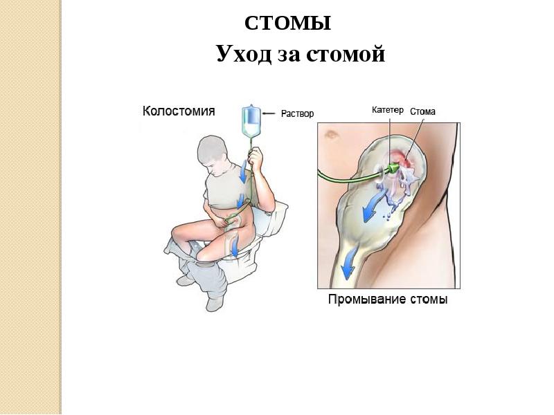 Виды стом презентация