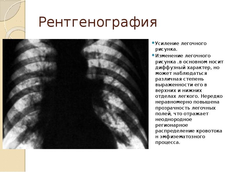 Уплотнен бронхососудистого рисунка